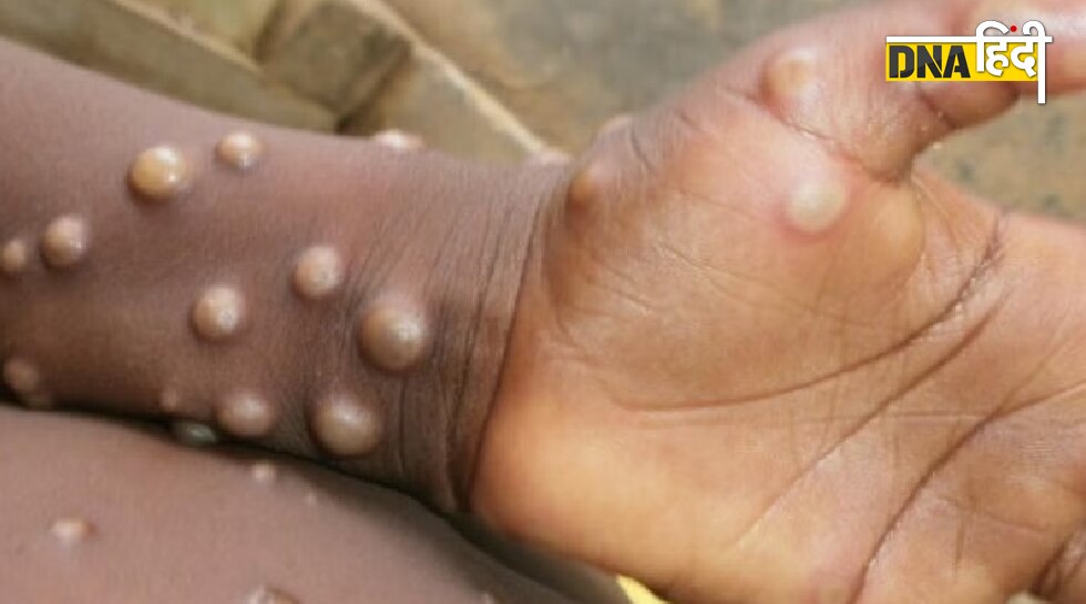 monkeypox