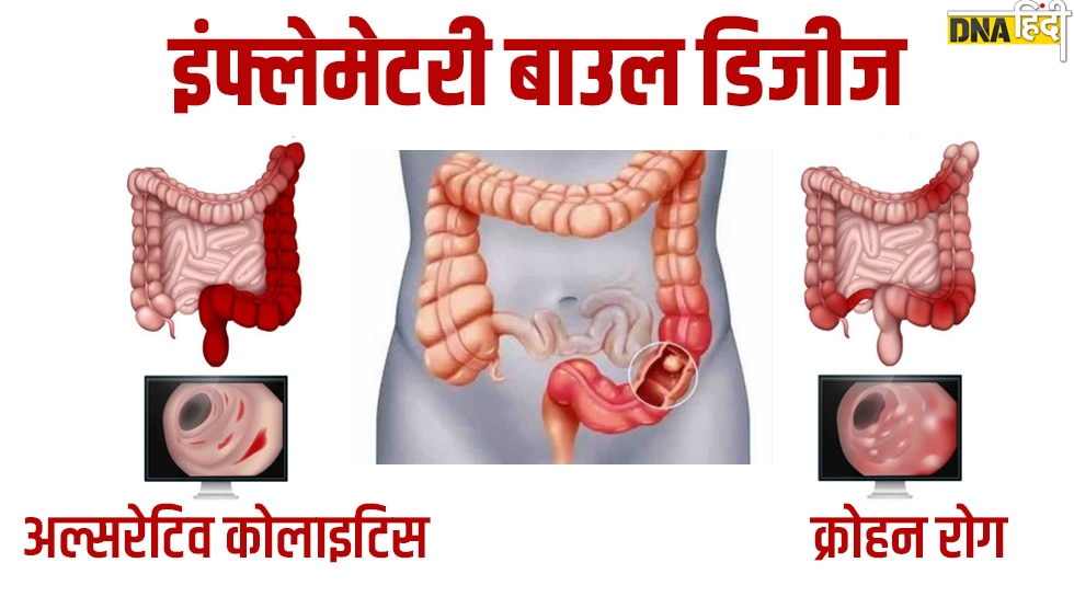 Inflammatory bowel disease