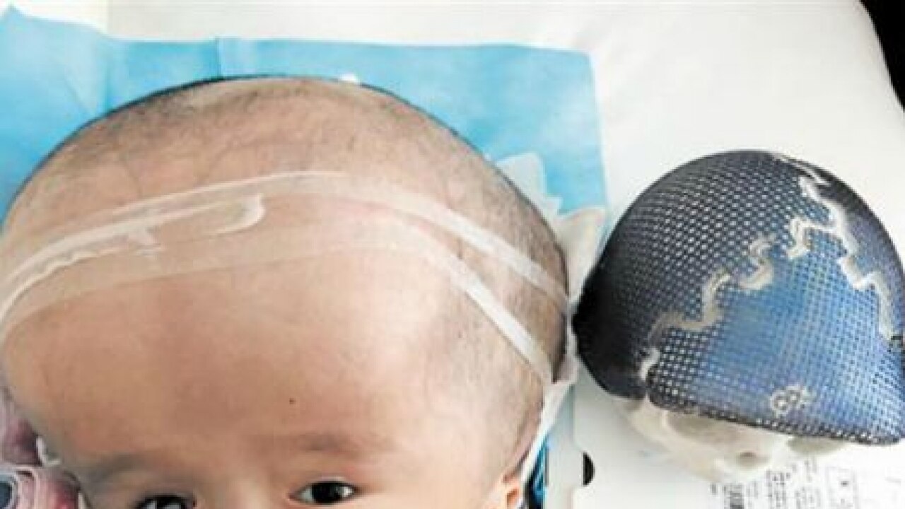 3d printed skull implanted in 3-year-old chinese girl