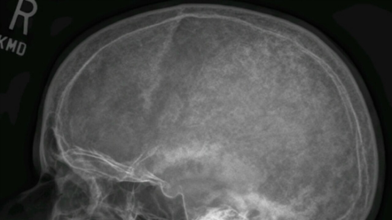 NASA helps develop osteoporosis and bone cancer test