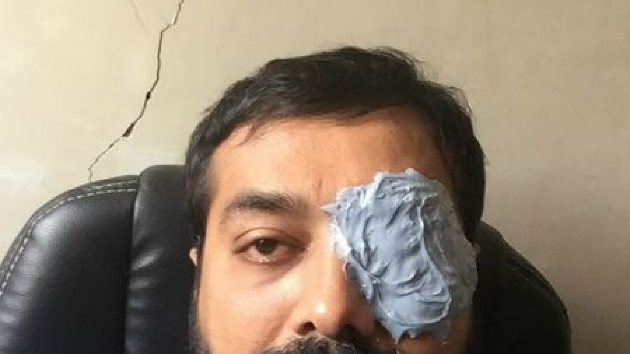 Why is anurag kashyap's eye bandaged?