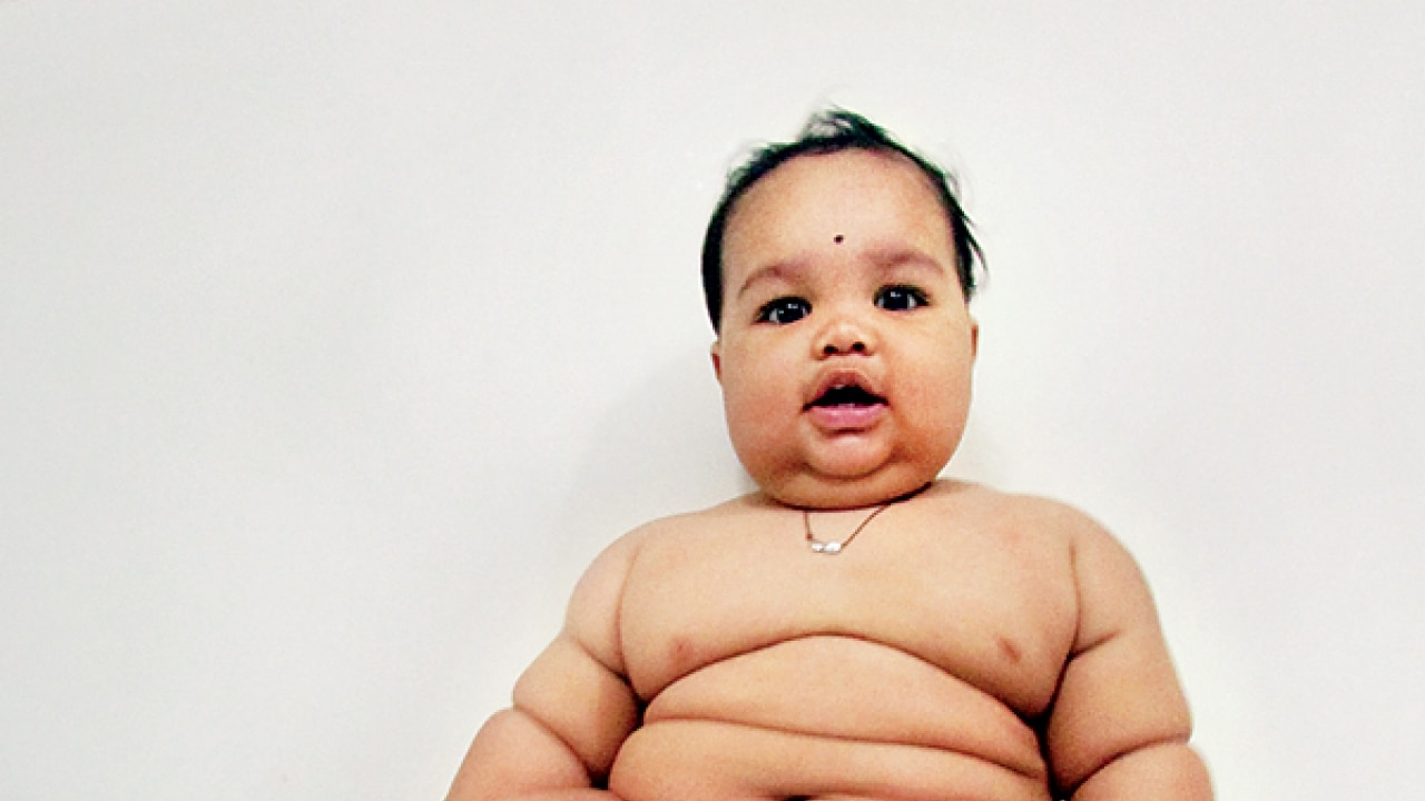 10 months old, but weighs 17 kg: Pune boy faces rare obesity surgery