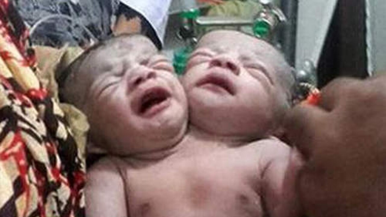 Baby with two heads born in bangladesh