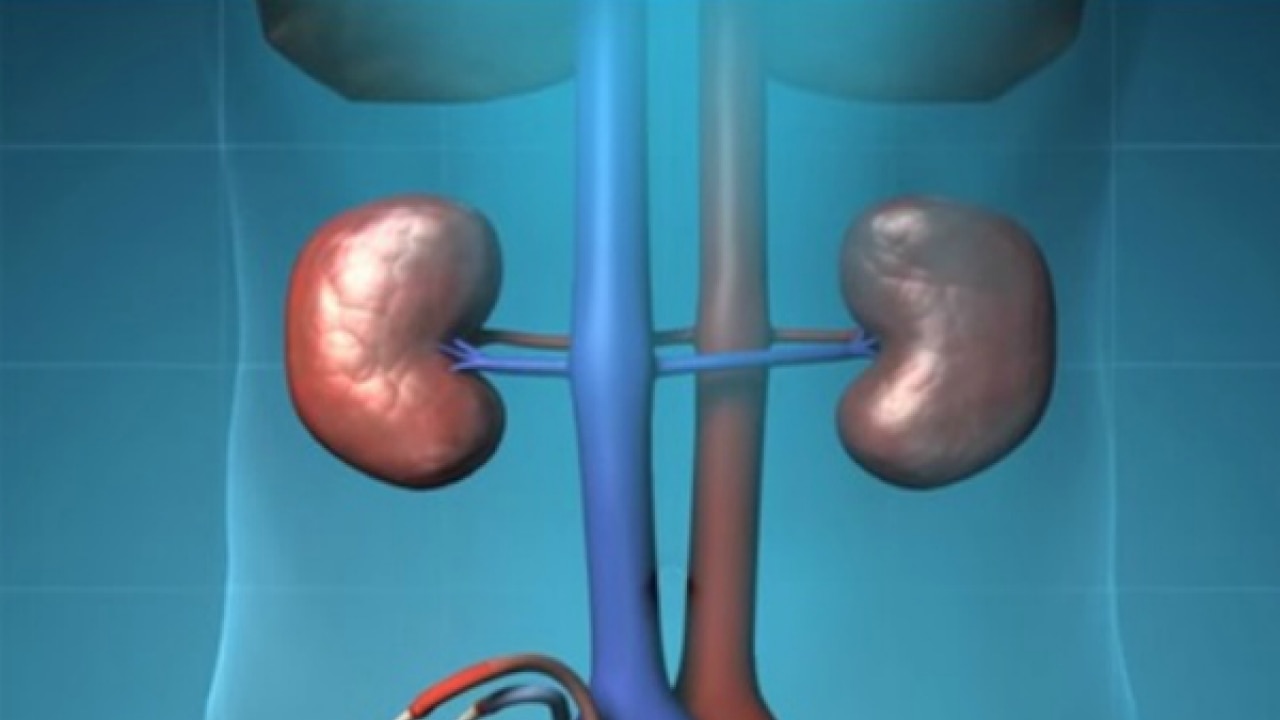 What Is Artificial Kidney