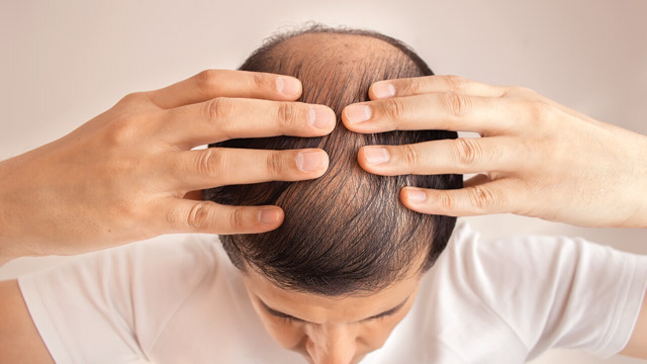How to treat hair loss in men  CHOSEN Store