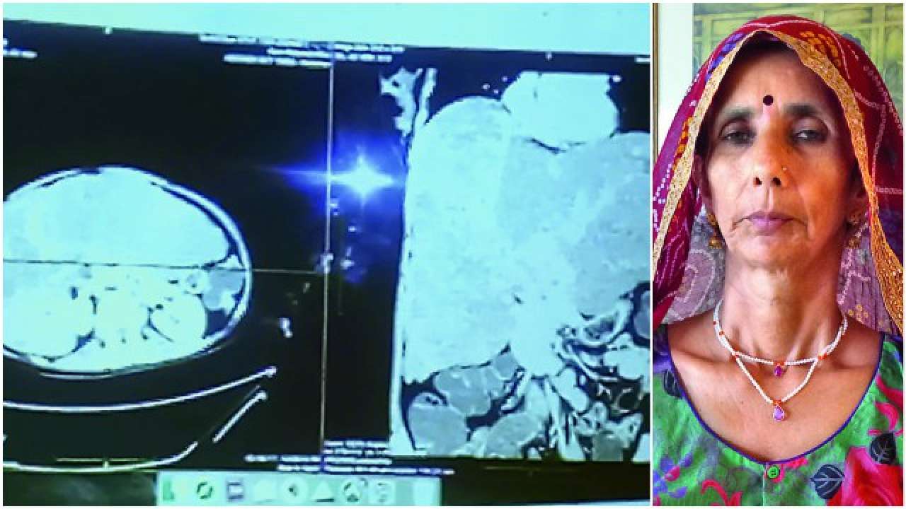 City docs remove one of the largest tumours in world