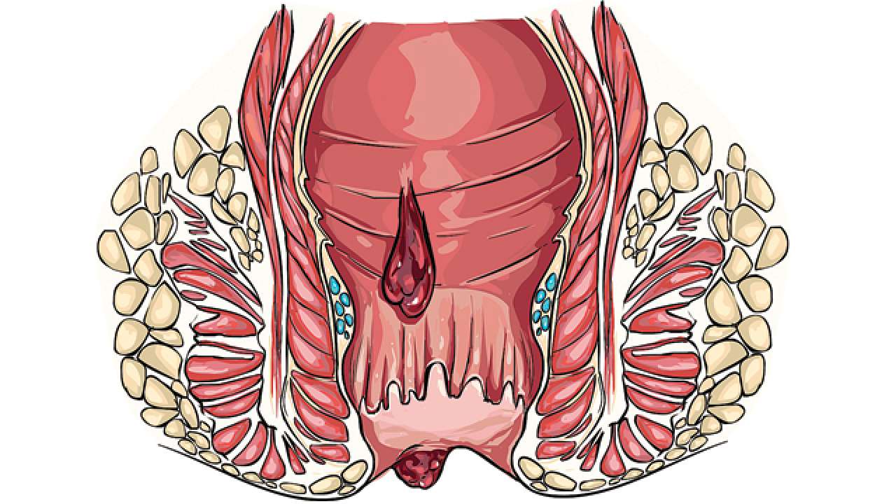 Novel Treatment For Anal Fistula