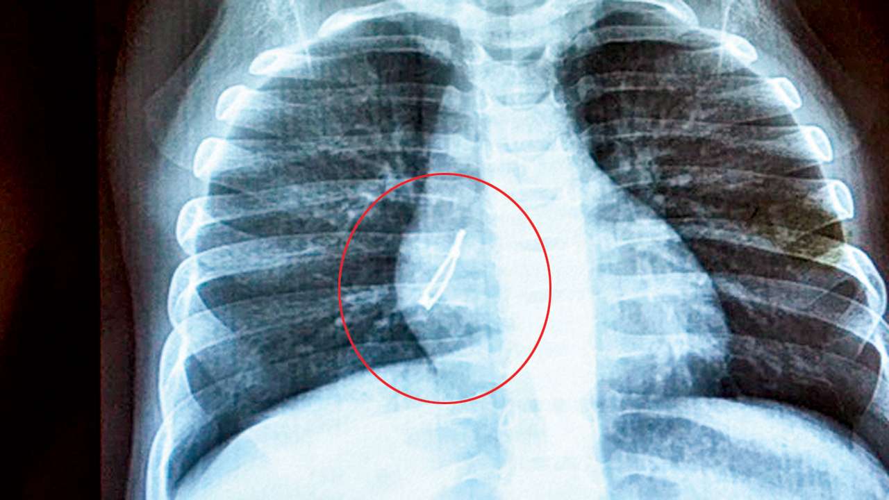 LED bulb found in baby�s lung