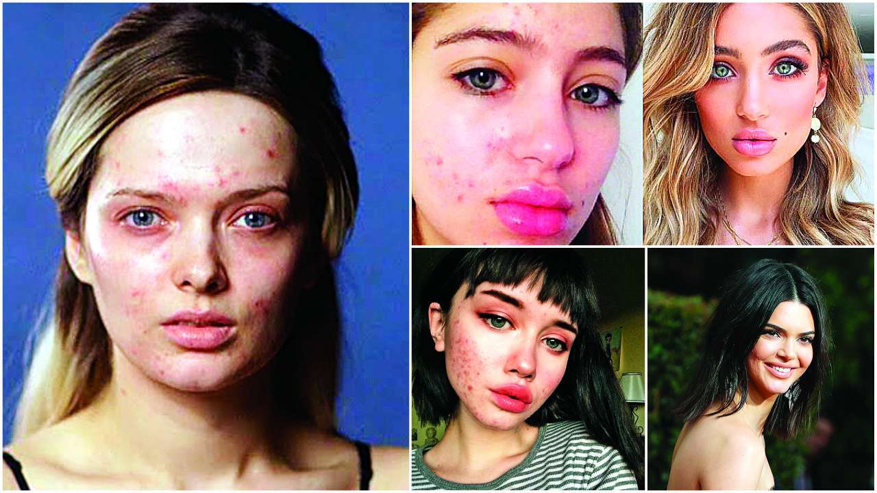 All about acne