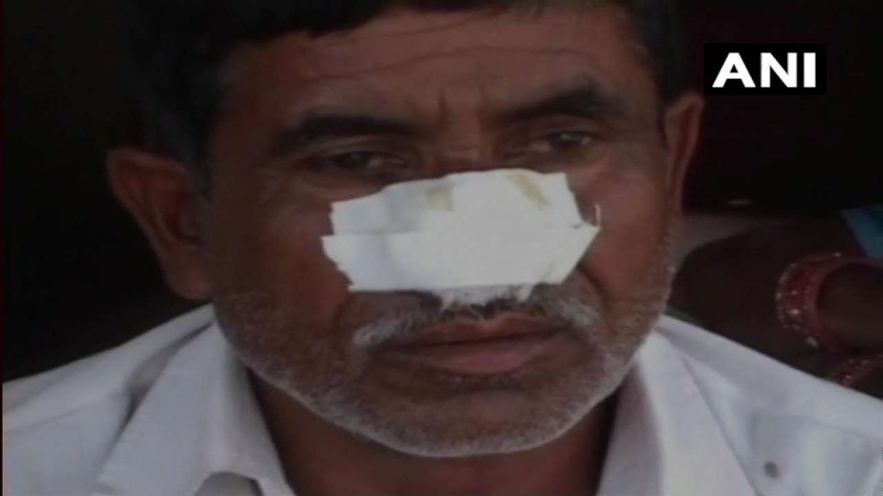 Uttar pradesh: denied money to drink alcohol, man gnaws off elder brother's nose in kannauj