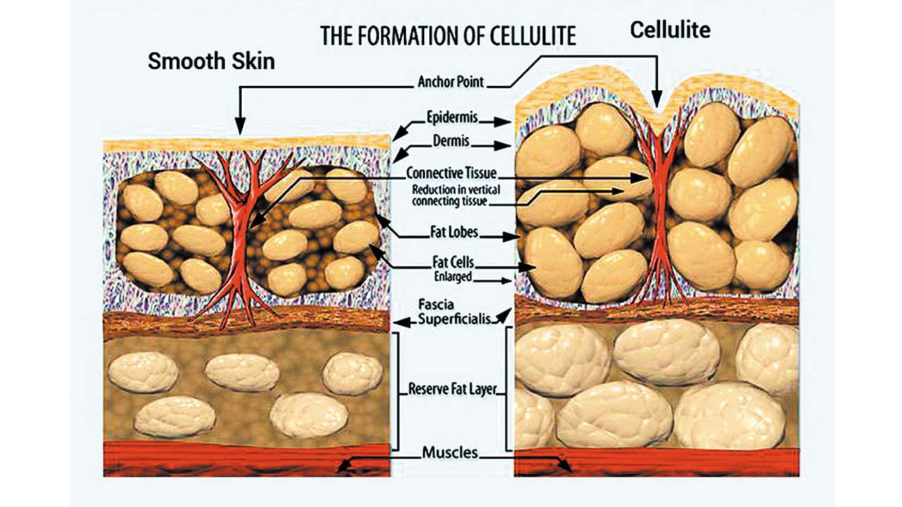 Say Goodbye To Cellulite