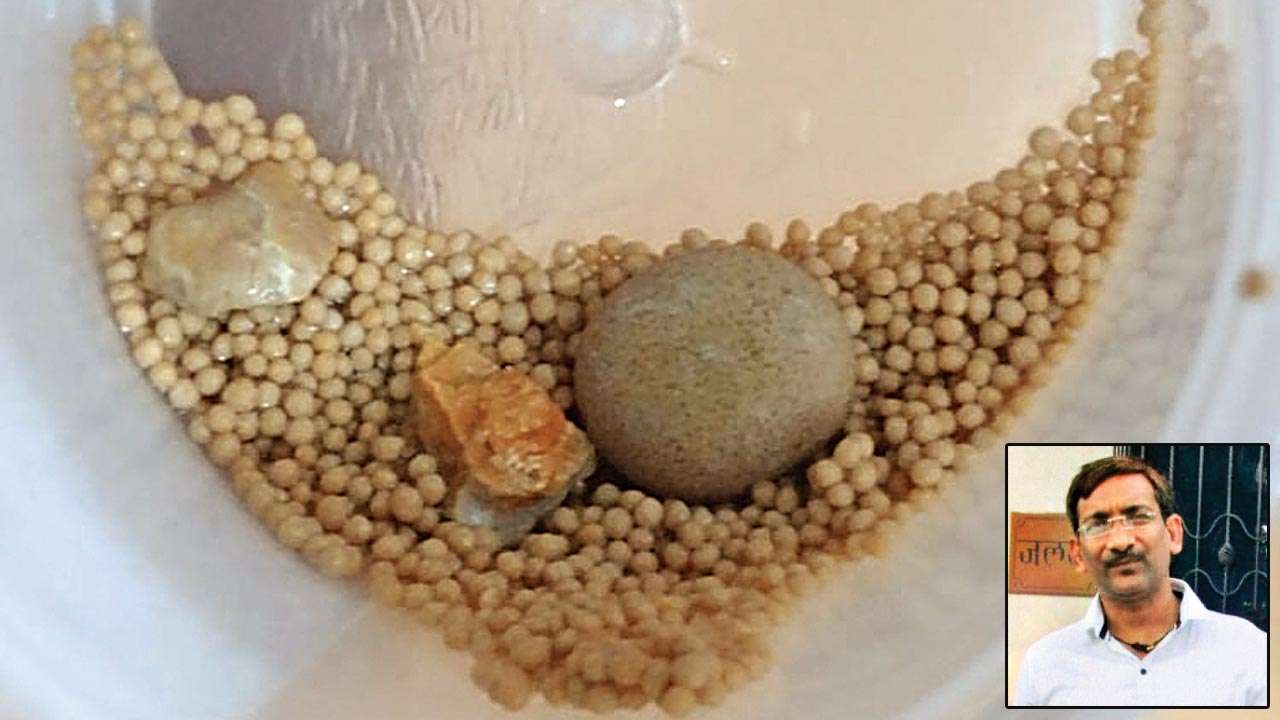 Delhi: 45-year-old gets 856 kidney stones removed from body
