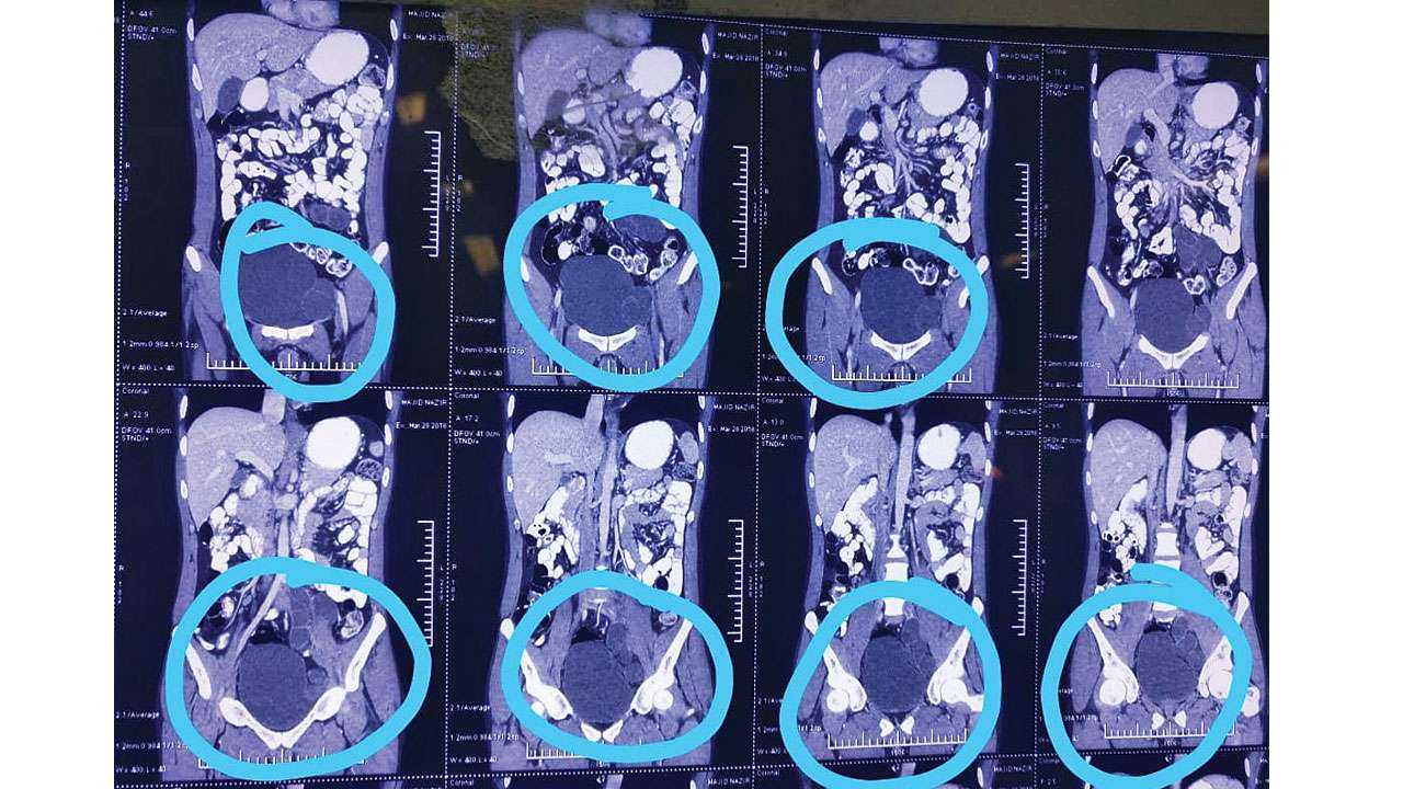 Delhi Man gets a ‘bigger than tennis ball’ cyst removed