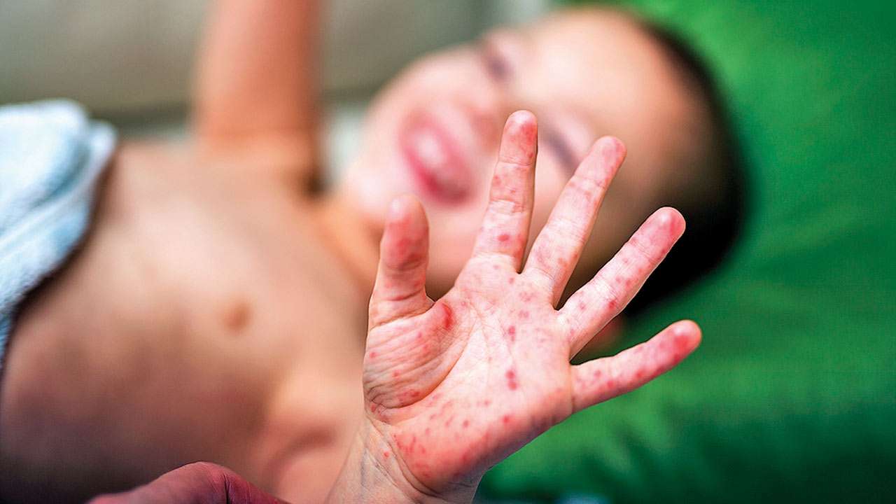 Measles