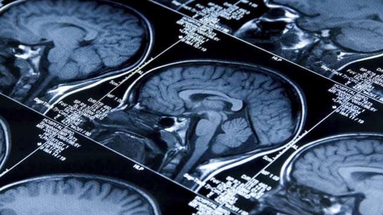 Scans Show Possible Link Between Brain >> Scans On Us Diplomats In Cuba Show Something Happened To The Brains Scans Show Possible Link Between Brain >> Scans On Us Diplomats In Cuba Show Something Happened To The Brains