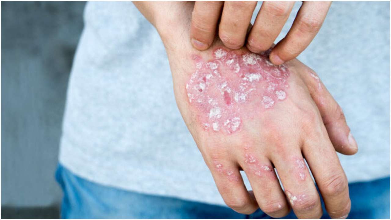 psoriasis skin disease symptoms