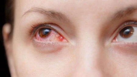 Red or bloodshot eyes