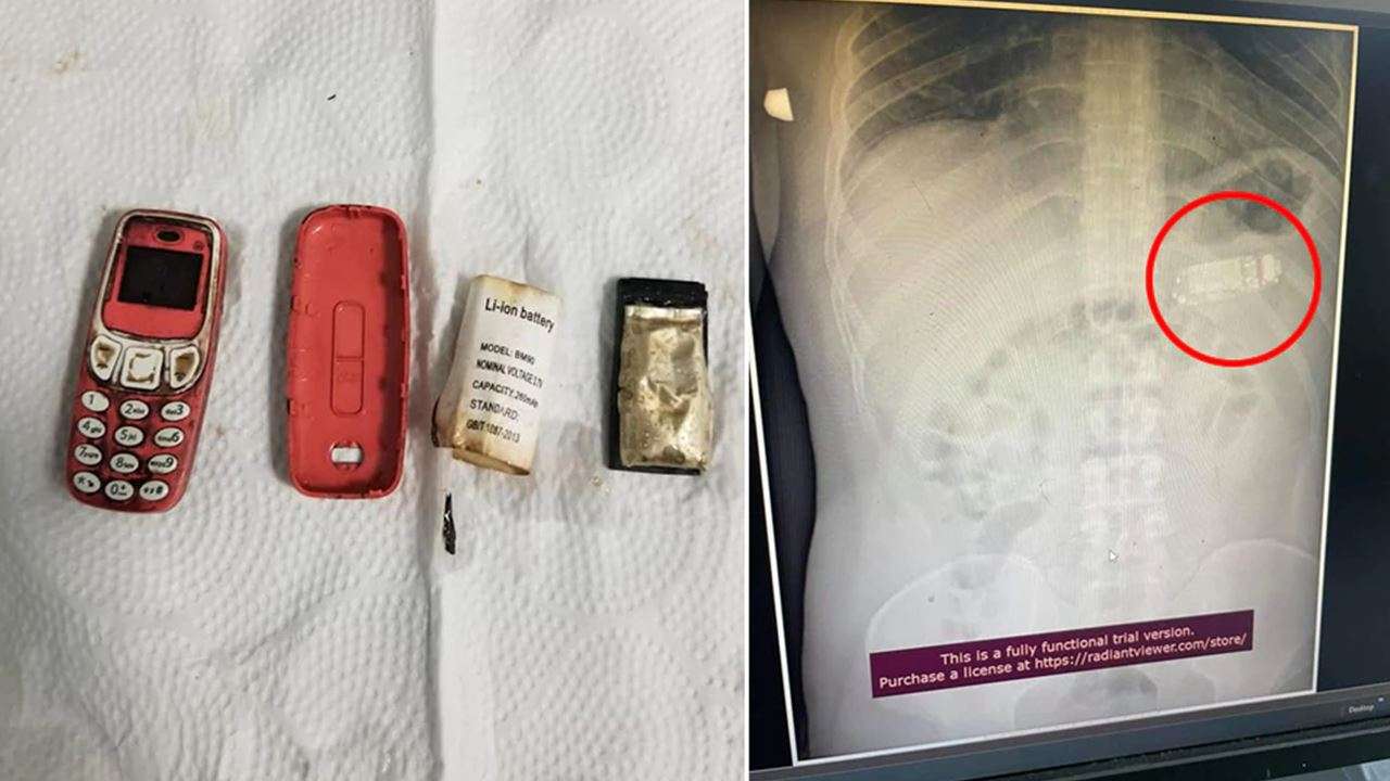 Man swallows entire Nokia 3310 mobile, undergoes surgery for removal