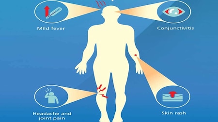 Symptoms of Zika virus disease