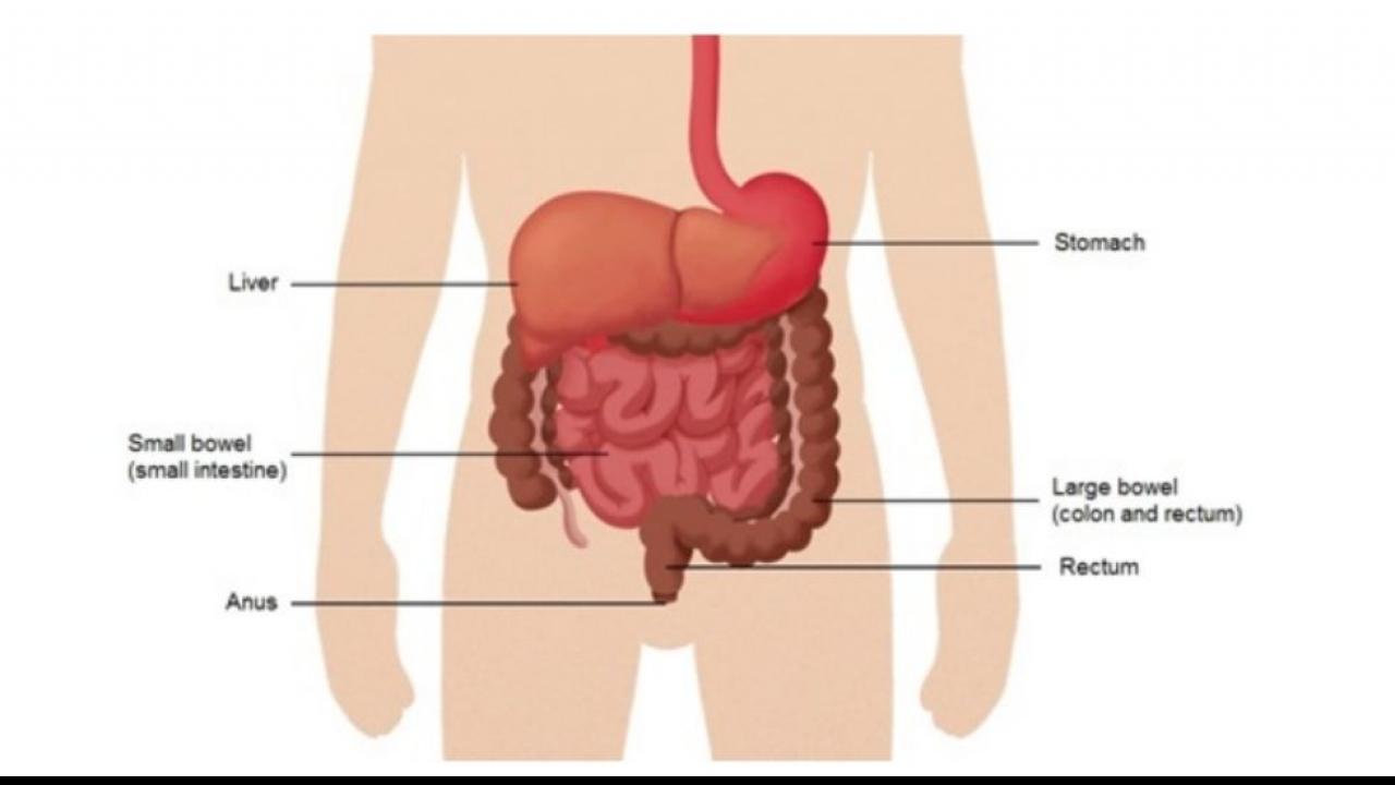 क्या होता है Bowel Cancer