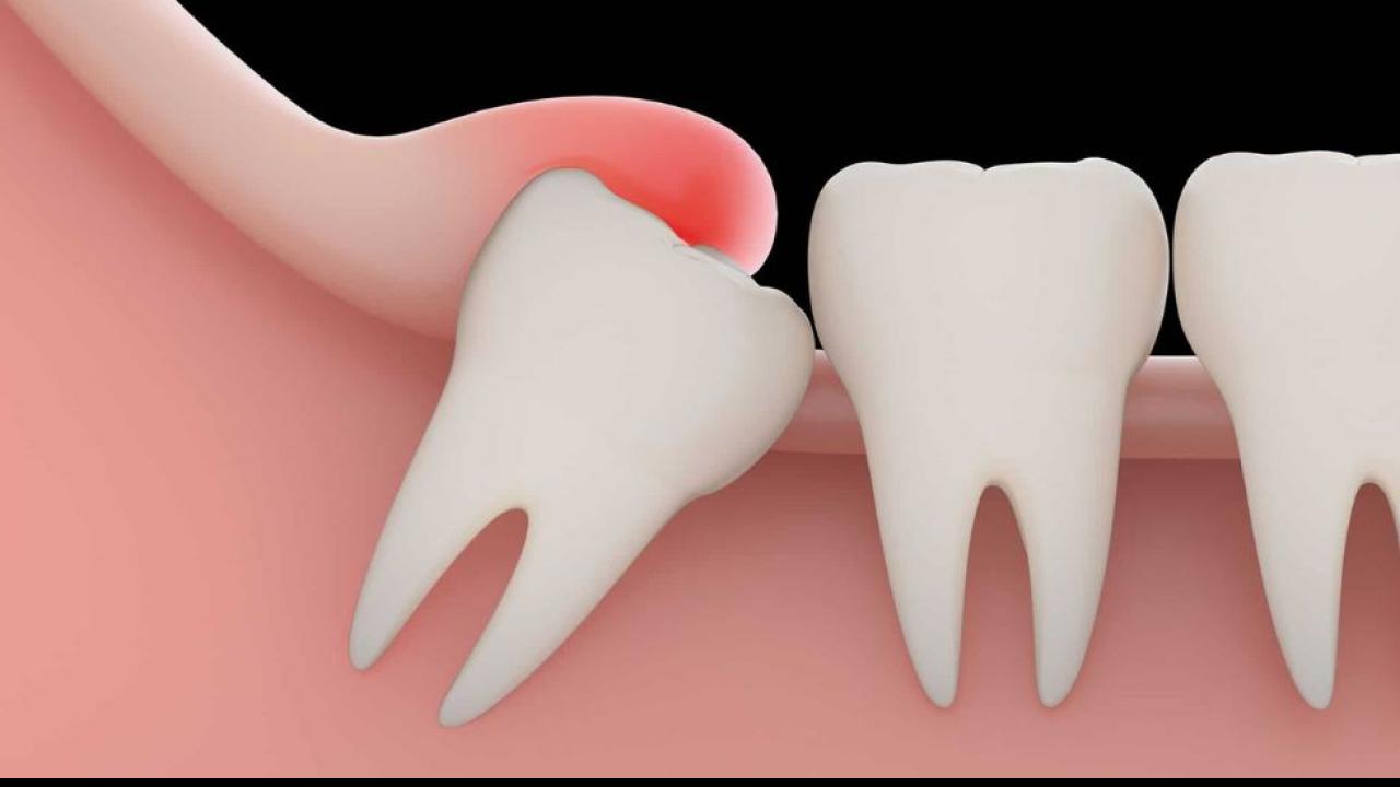 अकल दाढ़ (Wisdom Teeth)