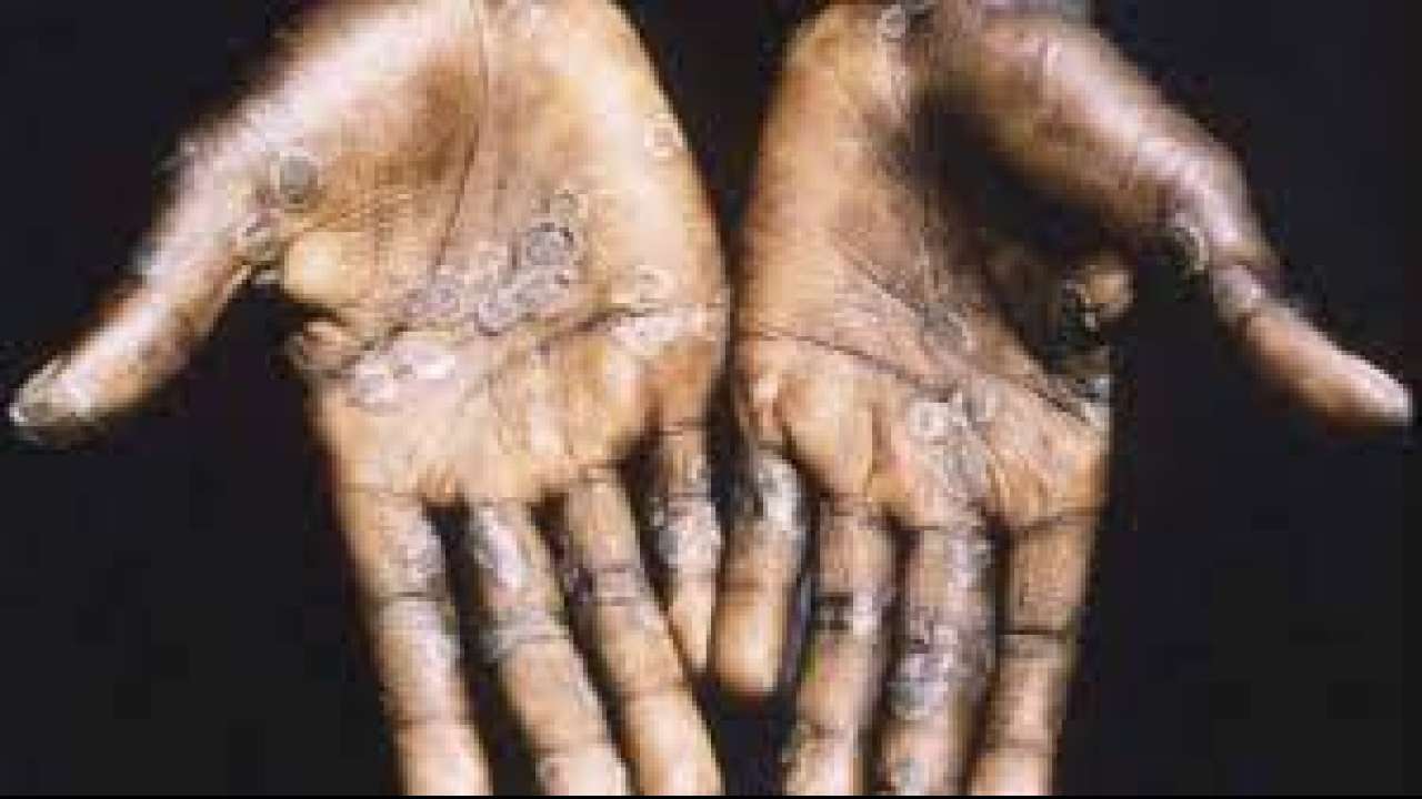 Symptoms of Monkeypox