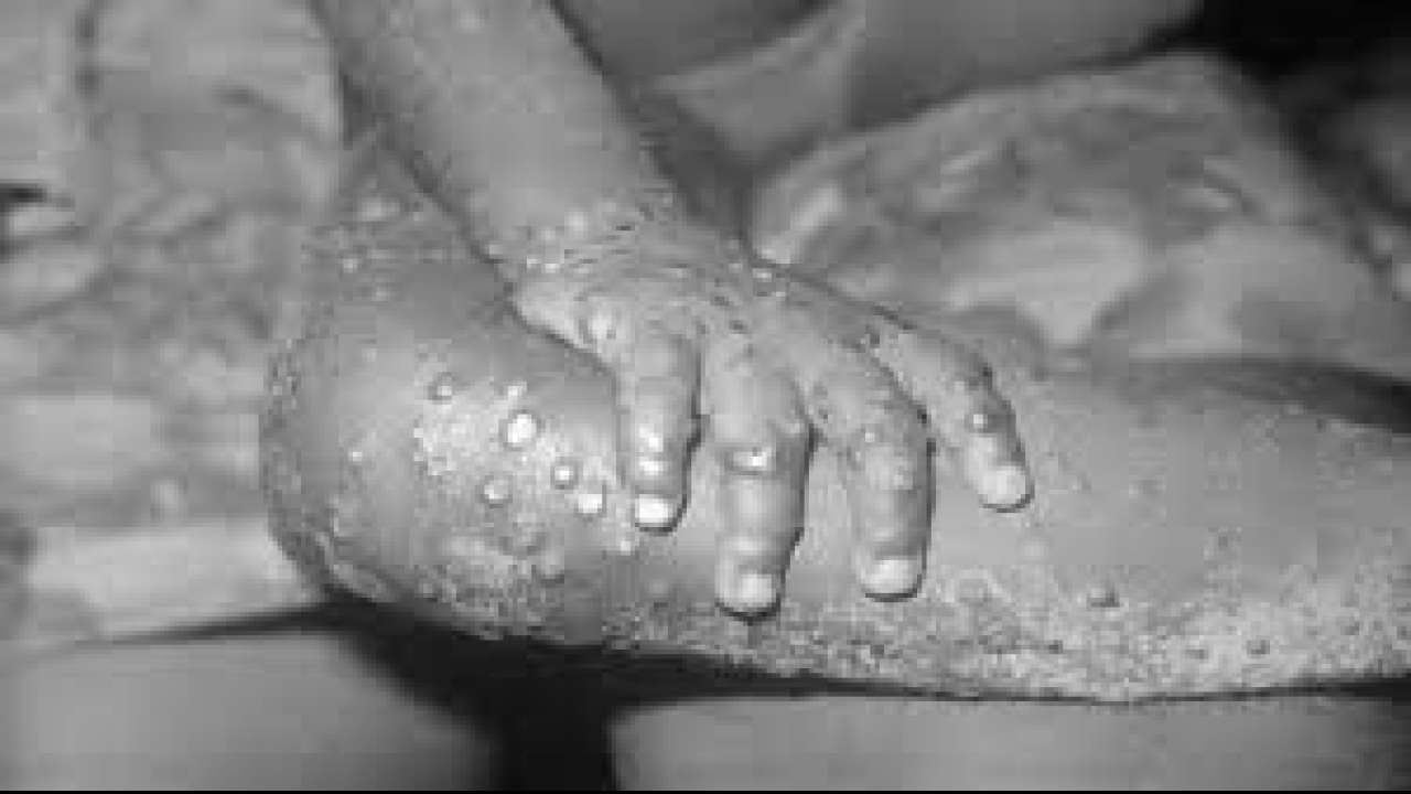 How can the monkeypox virus spread?