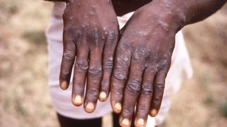More about Monkeypox