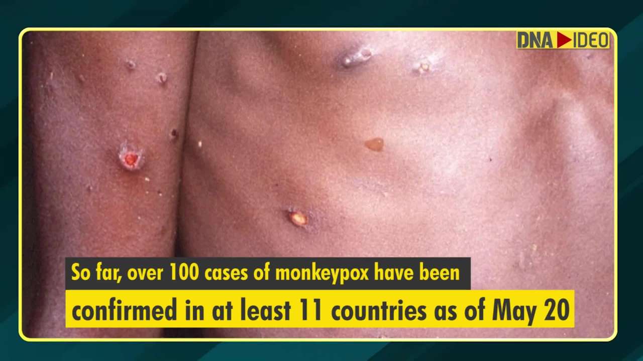 Monkeypox: Over 100 confirmed cases, spreads in 11 countries