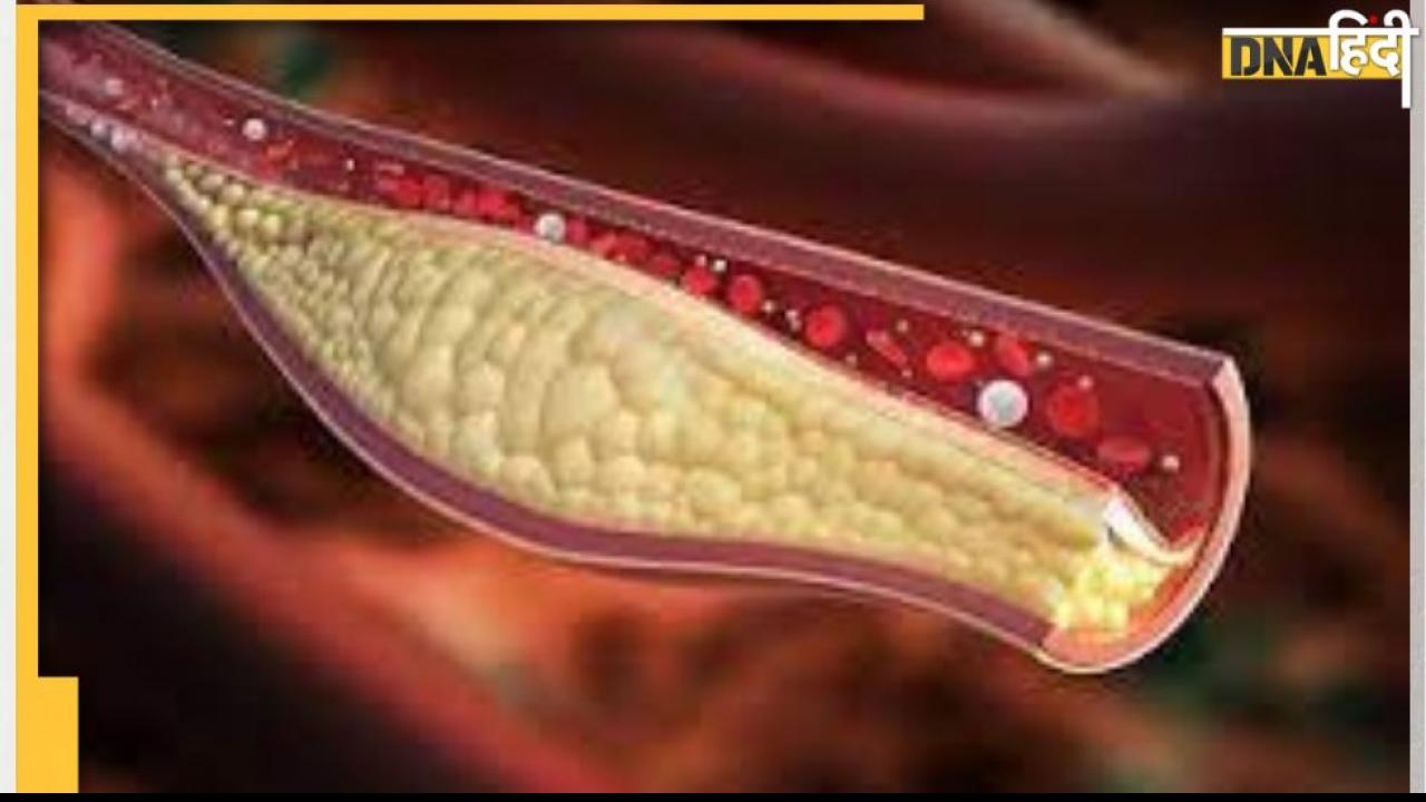 इन वजहों से नसों में भर जाता है गंदा Cholesterol, लापरवाही बरतने पर बढ़ जाता है हार्ट अटैक का खतरा