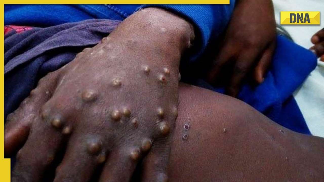Suspected monkeypox case found in kerala, all you need to know about the viral zoonotic disease