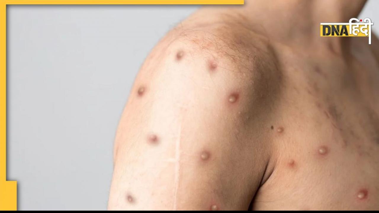 Monkeypox in India:देश में मंकीपॉक्स का दूसरा केस, दुबई से केरल लौटा था शख्स, सरकार अलर्ट पर