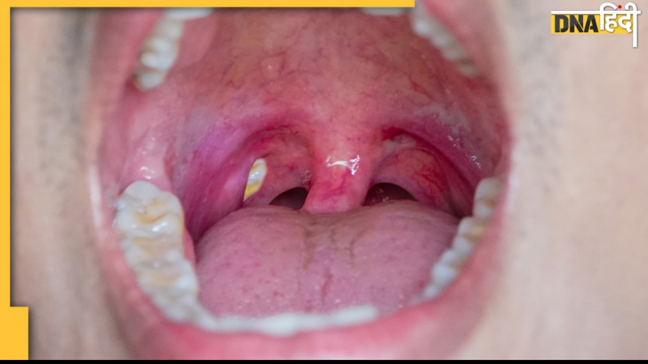 Tonsil Symptoms: बार बार गले में दर्द होना कहीं टॉन्सिल के संकेत तो नहीं, तुरंत करें ये उपाय