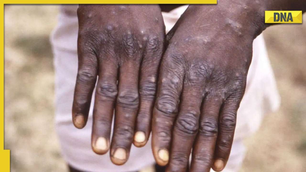 Delhi reports first case of monkeypox, 31-year-old man with no travel history hospitalised