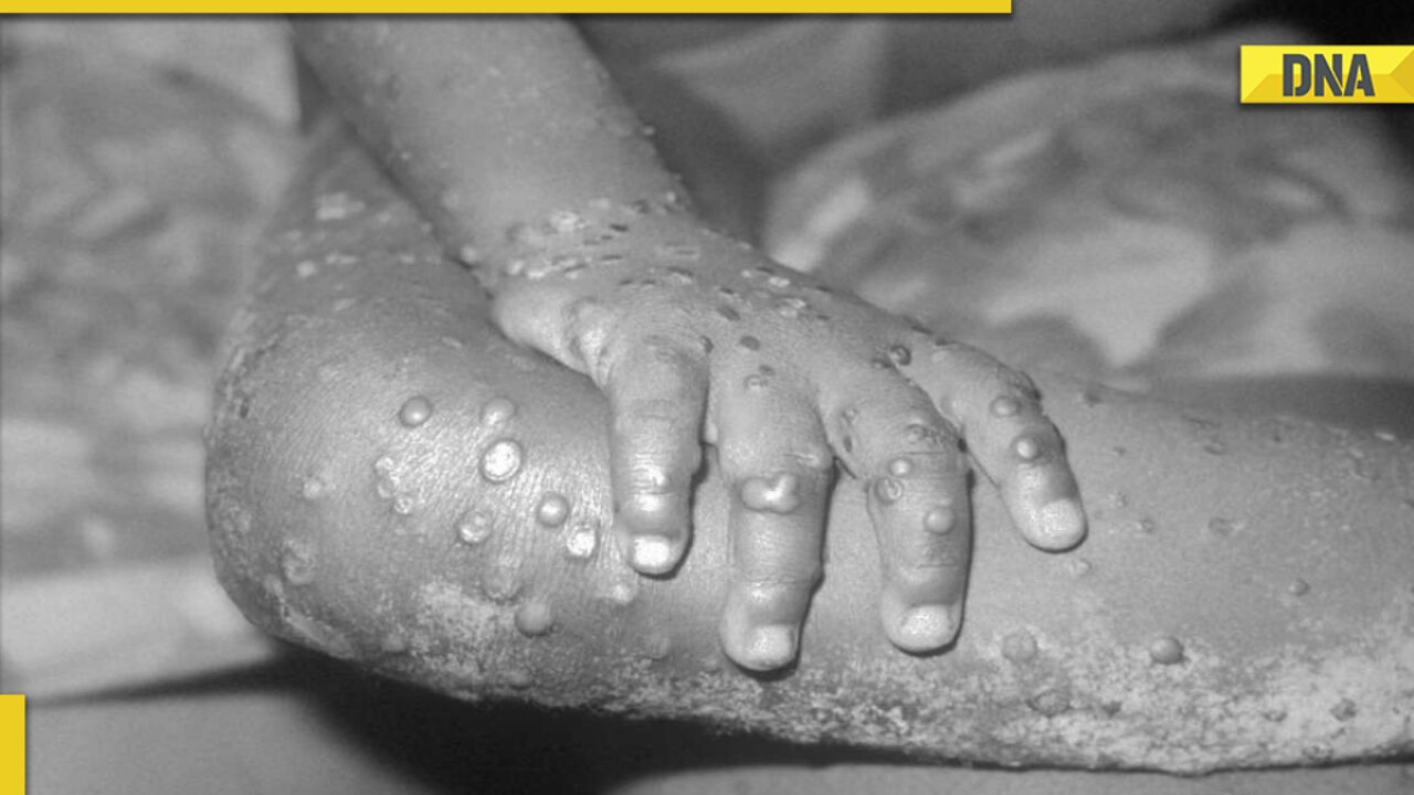 Monkeypox in Delhi, Kerala: What is the Centre doing to stop its spread? How to prevent monkeypox infection?