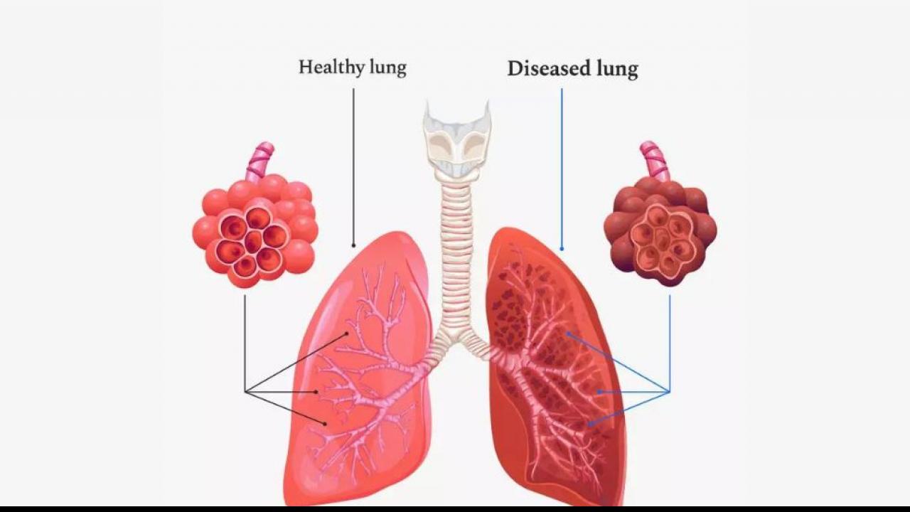 Acute Lung Disease: फेफड़े की गंभीर बीमारी है COPD, लंग्स की वीकनेस और सूजन से आजीवन रहेंगे खांसते, जान लें लक्षण