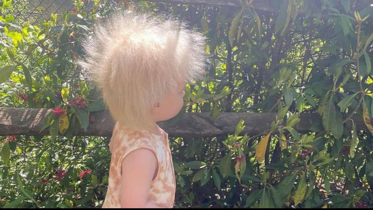 Uncombable Hair Syndrome