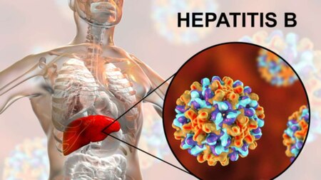 Hepatitis B