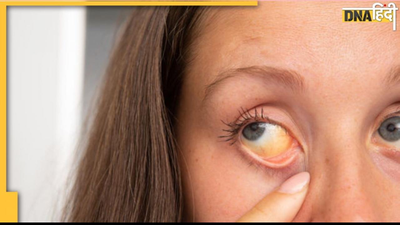 Eyesight: आंखों में ये धब्‍बे हाइपरटेंशन और हाई कोलेस्ट्रॉल का भी हैं साइन, ऐसे पहचानें लक्षण 
