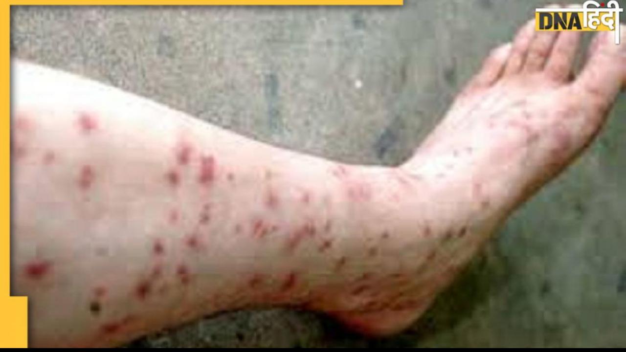 Corona Vs Monkeypox: कोरोना जैसी महामारी नहीं बनेगा मंकीपॉक्स, क्या है Expert की राय
