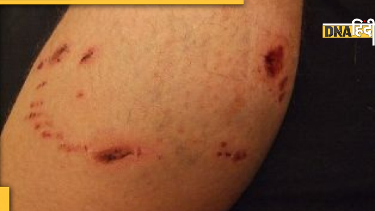 First Aid for Dog Bite: कुत्ता काटते ही अपनाएं ये घरेलू उपाय, तुरंत मिलेगी राहत