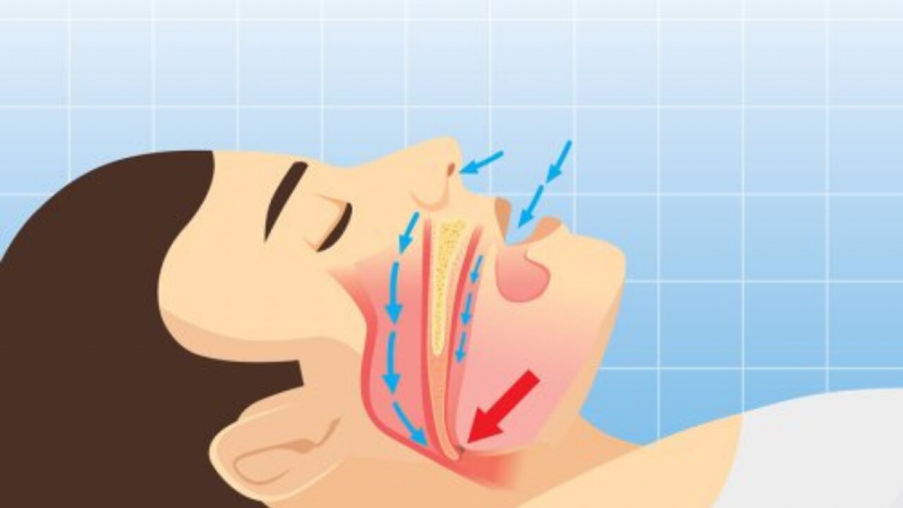 खर्राटे की समस्या का कारण 