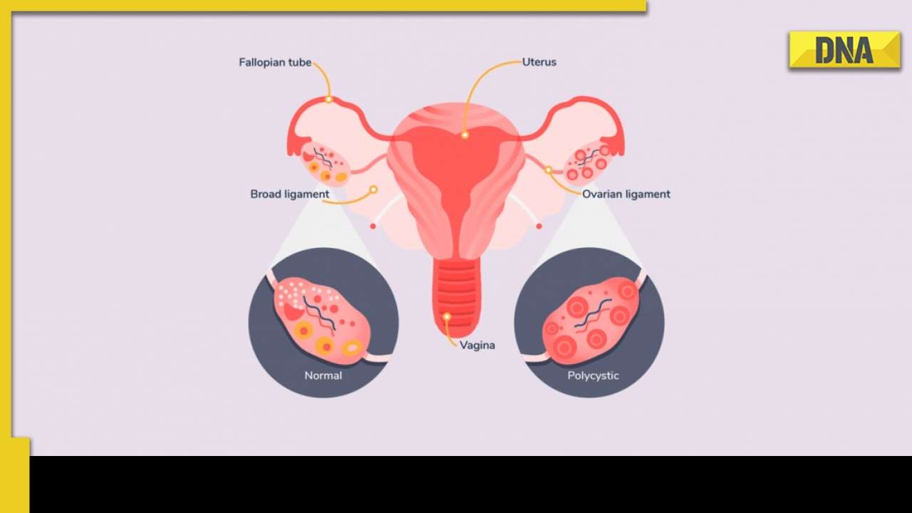 Polycystic ovarian syndrome: What are the symptoms of PCOS and how ...