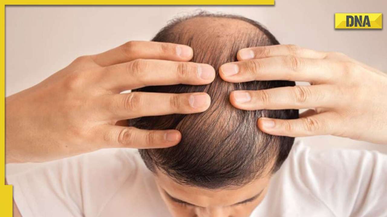 Male Pattern Baldness What Causes Hair Loss in Men And How it Can be  Treated