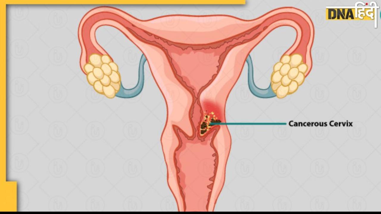 Cervical Cancer Cure: माइक्रो आरएन से होगा सर्वाइकल कैंसर का इलाज, बीएचयू के वैज्ञानिकों ने खोजी यह थेरेपी