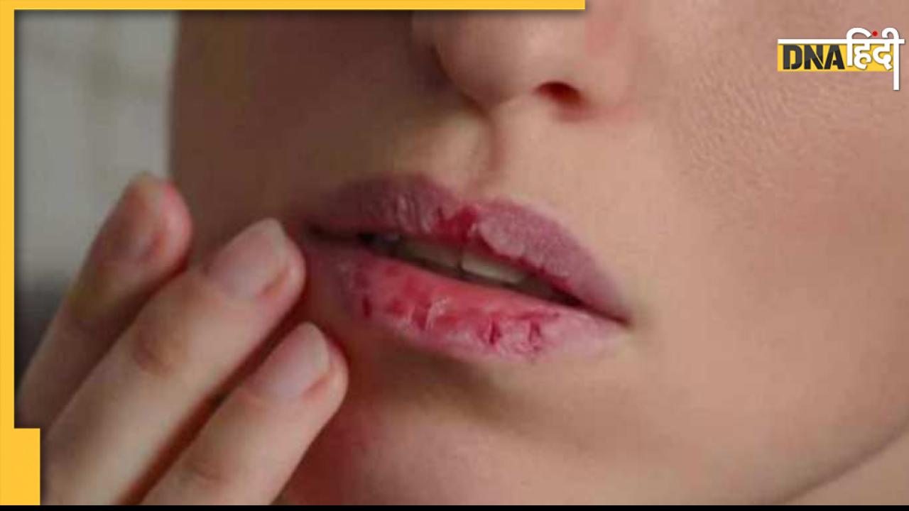 Chapped Lips Home Remedies: फटे होंठ पर जब न आए कोई उपाय काम, तो ये टिप्स दिलाएंगे तुरंत आराम