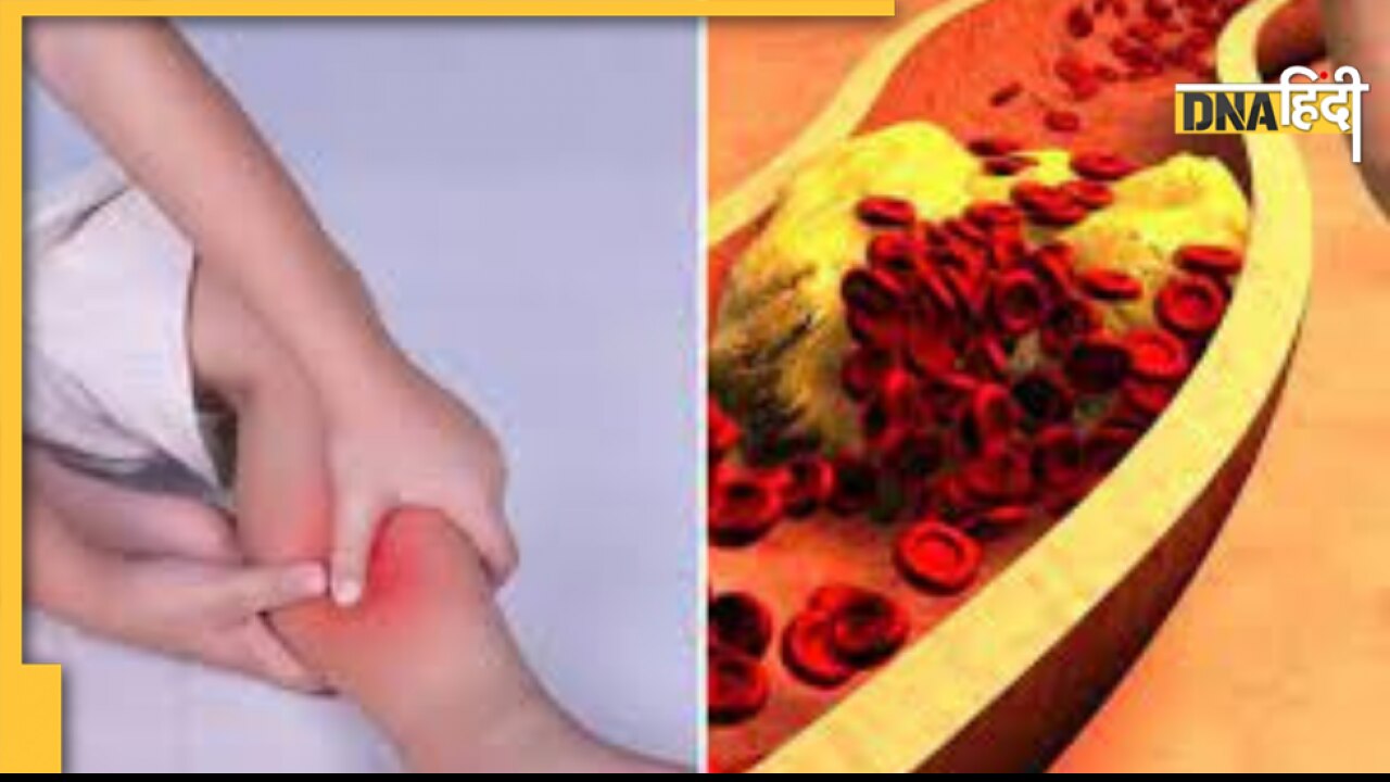 High Cholesterol Sign: पैरों में ऐंठन और जलन से समझ लीजिए खून में जमने लगा है गंदा कोलेस्ट्रॉल, ये हैं शुरुआती लक्षण