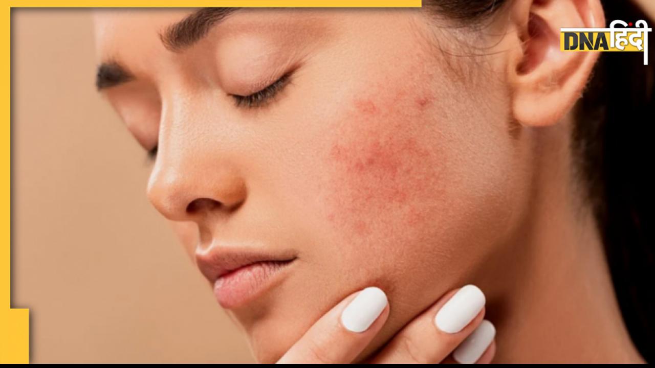 Remedies For Pigmentation: इन होममेड फेस पैक से चेहरे की जिद्दी झाइयां होंगी दूर, ये है बनाने का तरीका
