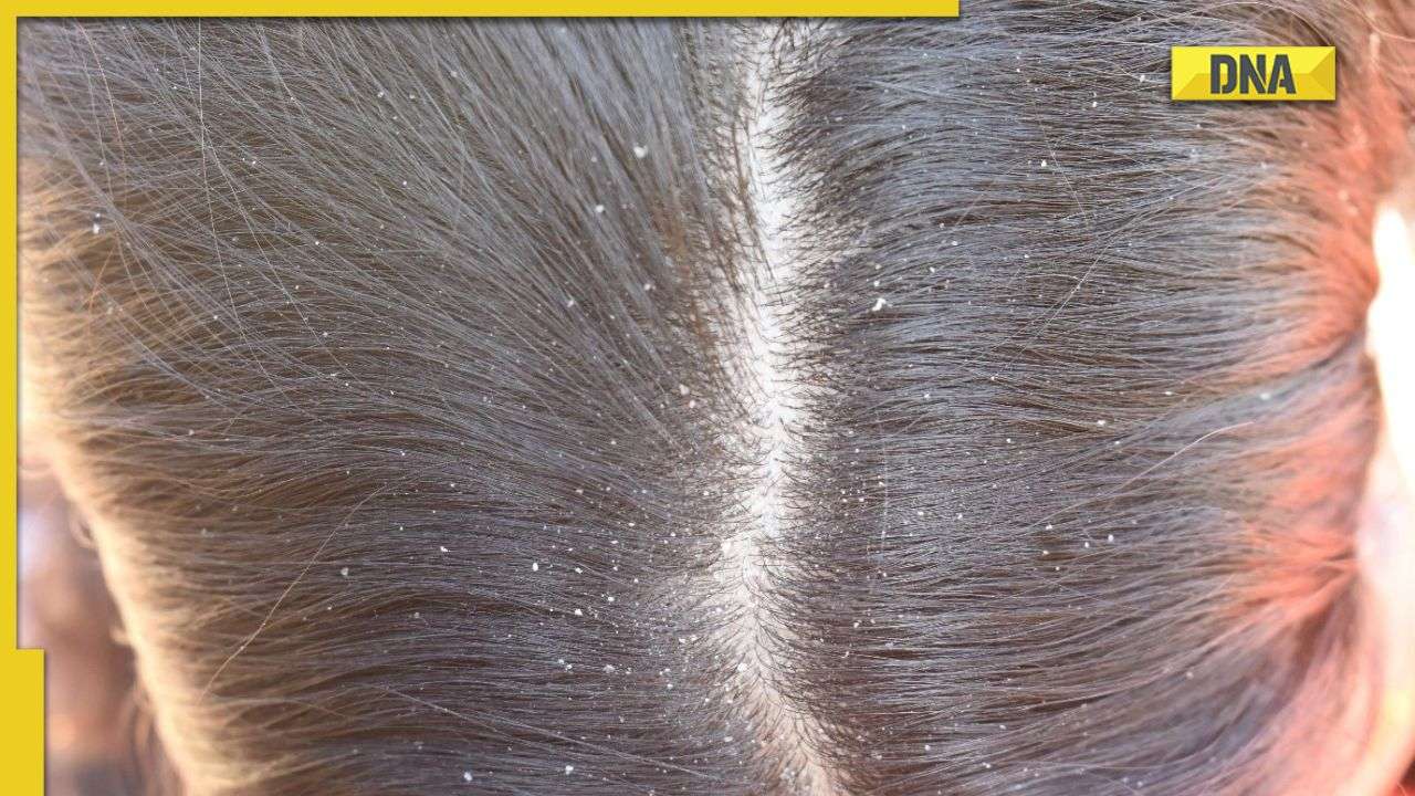 Haircare in winter: 5 effective home remedies to treat dandruff