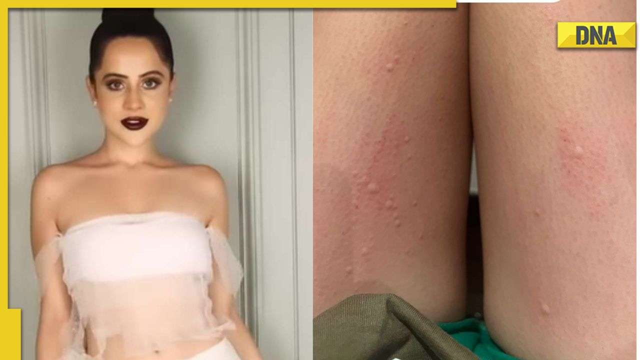 Urfi Javed gets boils after wearing woollen outifts, justifies her fashion choices by saying 'I am allergic to clothes'
